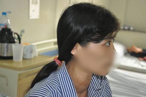 Biến chứng nghiêm trọng khi điều trị basedow không đúng cách