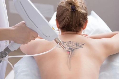Xóa xăm bằng laser có để lại sẹo?