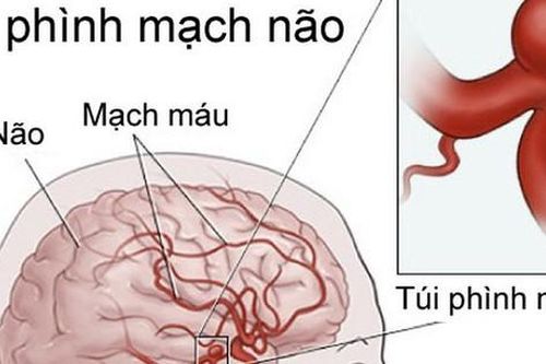 Phình mạch máu não phát hiện bằng cách nào?