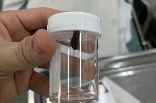 Con vắt sống trong hốc mũi bé gái suốt 10 ngày