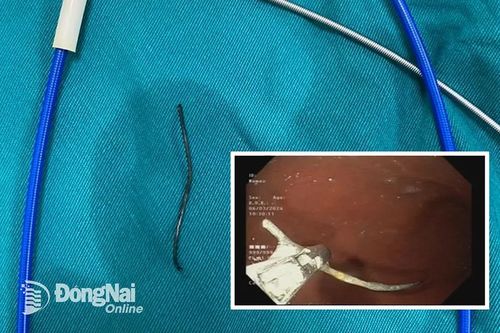 Nội soi gắp cọng kẽm dài 3cm trong dạ dày