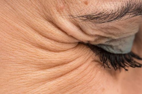 Làm gì để ngăn ngừa vết chân chim?
