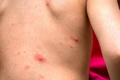 Bệnh nhân sởi có thể lây cho bao nhiêu người?