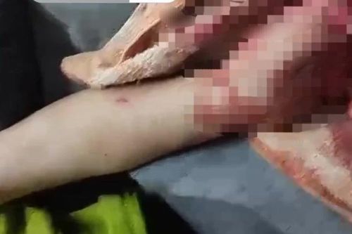 Làm rõ vụ pháo nổ khiến bé trai 4 tuổi bị thương nặng
