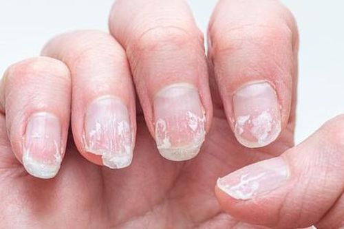 6 dấu hiệu trên móng tay cảnh báo vấn đề sức khỏe nghiêm trọng