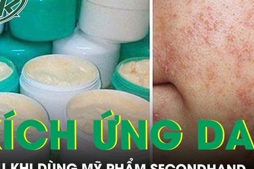 Phồng rộp môi sau khi dùng mỹ phẩm 'secondhand'