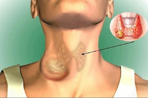 Người bệnh ung thư tuyến giáp sau khi uống iod phóng xạ cần lưu ý gì?