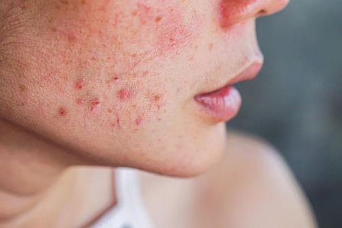 Da mặt nát tươm vì tinh chất hồng sâm