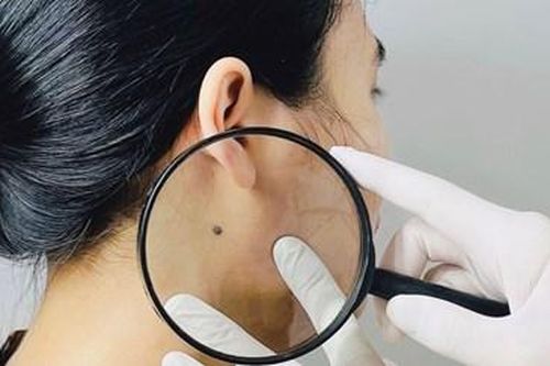 Bệnh viện Trung ương Huế tầm soát ung thư da miễn phí cho 50 bệnh nhân