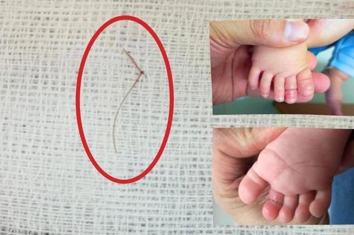 Bé gái 4 tháng tuổi suýt mất ngón chân vì sợi tóc
