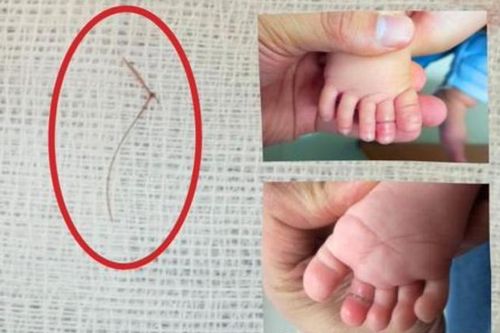 Sợi tóc thắt vào chân, bé gái 4 tháng tuổi suýt mất ngón