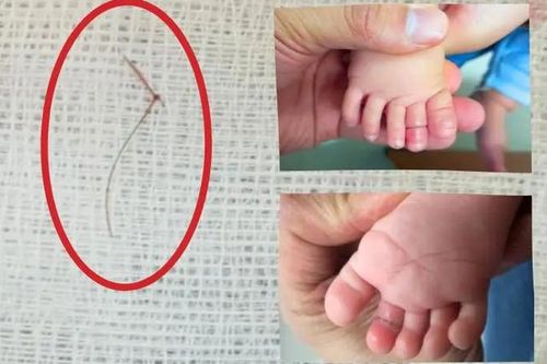 Bé gái 4 tháng tuổi suýt mất ngón chân vì sợi tóc nhỏ