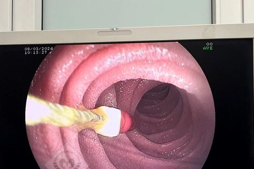 Đi chữa răng, bé trai 8 tuổi bị kim rơi vào tá tràng