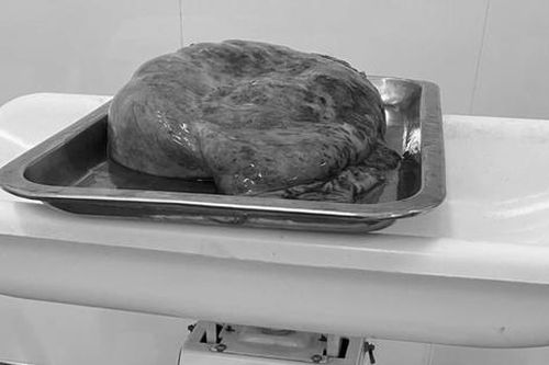 Thành công cắt bỏ khối u buồng trứng nặng 2 kg và ruột thừa viêm cấp