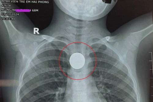 Cứu sống bé trai 6 tuổi nuốt đồng xu vào thực quản