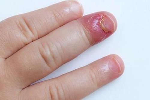Biện pháp điều trị chín mé có mủ ở tay, chân