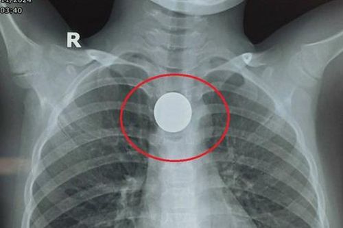 Bé 6 tuổi bất ngờ nuốt đồng xu khi đang chơi với bạn