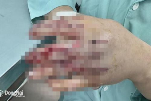 Một người ở Định Quán bị máy ép nước mía nghiền nát bàn tay