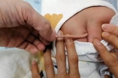 Bé sơ sinh ở Trung Quốc có đuôi dài 10cm mọc ra từ lưng