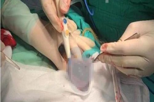 Nam thanh niên bị vỡ tinh hoàn khi chơi đá bóng