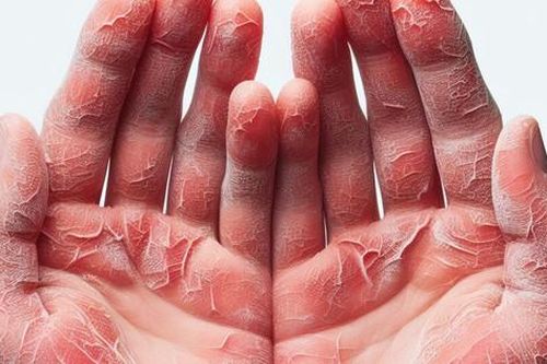 Câu hỏi thường gặp liên quan đến bệnh viêm da cơ địa