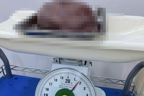 Cắt bỏ khối u gần 2kg cho sản phụ 19 tuổi