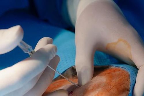 Nữ Việt kiều tử vong khi làm đẹp: Do ngộ độc thuốc tê?