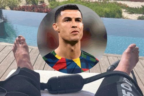 Ngón chân biến dạng của Ronaldo