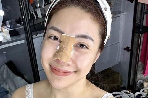 Nữ ca sĩ Việt sửa mũi, sau 12 năm bị viêm nặng, chịu cảnh 'đau tới não' khi tháo sụn