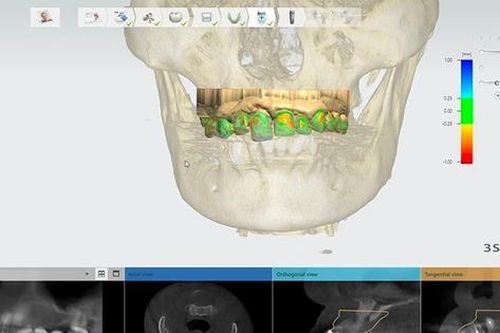 Cấy ghép implant 4.0: Tiên tiến với công nghệ AI