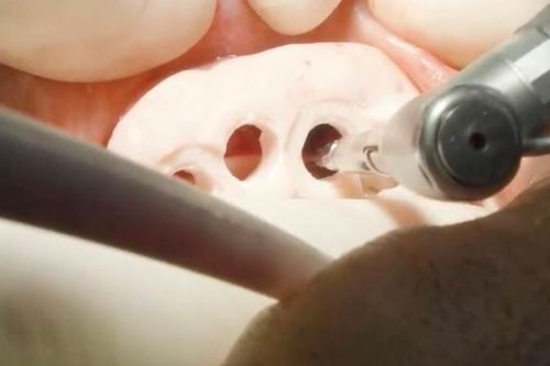 Máng định vị 3D Guide – Giảm nguy cơ biến chứng sau cấy ghép implant