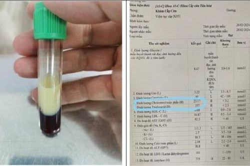Cứu sống bệnh nhân biến chứng viêm tụy cấp do tăng mỡ máu