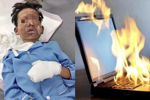 Bé trai 8 tuổi bỏng nặng do laptop phát nổ