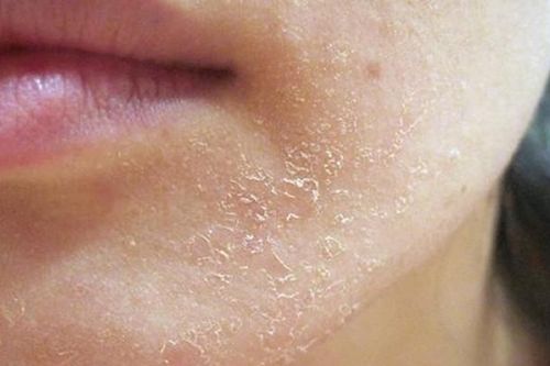 Làm gì khi da bị khô, ngứa, nứt nẻ?