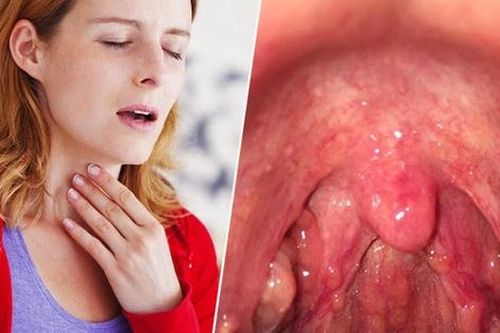 Bất ngờ 5 biến chứng đáng sợ của viêm họng mãn tính rất nhiều người không biết