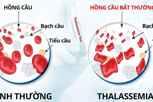 Bệnh tan máu bẩm sinh: Nguy hiểm nhưng dễ phòng tránh