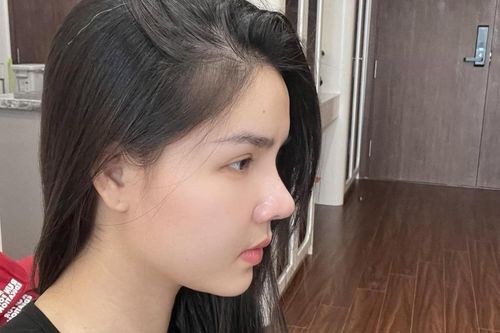 Kỳ Hân lộ dấu hiệu tuổi già sau khi 'đụng' dao kéo