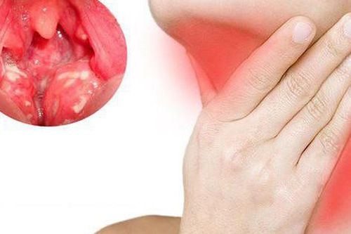 Lưu ý khi dùng quả la hán chữa viêm họng