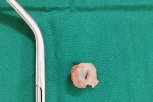 Liên tiếp nhiều trẻ bị hóc dị vật đe dọa tính mạng