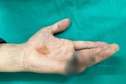 Suýt phải cắt bỏ ngón tay do chủ quan khi bị điện giật