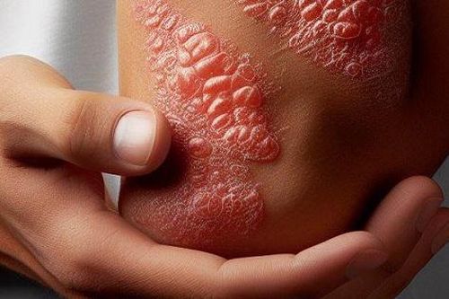 Vảy nến: Nguyên nhân, triệu chứng và cách điều trị