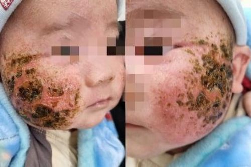 Bé trai 4 tháng tuổi nhập viện do đắp lá thuốc nam tự chữa viêm da tại nhà