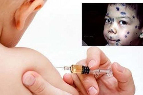 Tiêm vắc xin thủy đậu thế nào để tránh biến chứng?
