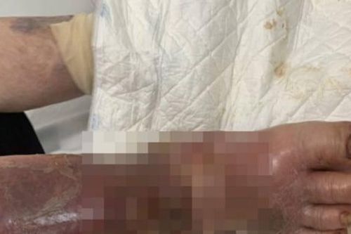 Bệnh nhân đái tháo đường nguy kịch do thường xuyên sử dụng thuốc giảm đau