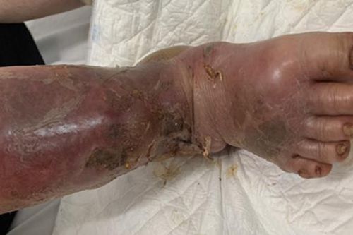 Cảnh báo lạm dụng thuốc Medrol gây suy tuyến thượng thận