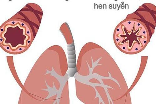 Cách mới để hạn chế các cơn hen suyễn