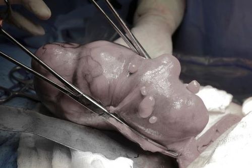 Nữ bệnh nhân 57 tuổi 'trút' được khối u hơn 1kg ra khỏi người