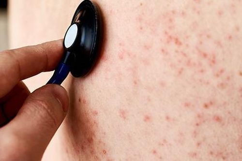 Nhiều trường hợp mắc rubella, dấu hiệu nào nhận biết bệnh sớm?
