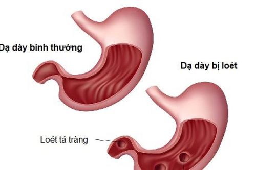 Xuất huyết tiêu hóa do viêm loét dạ dày tá tràng ở trẻ em