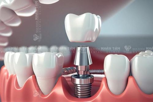Implant cá nhân hóa: Tương lai của nụ cười hoàn hảo